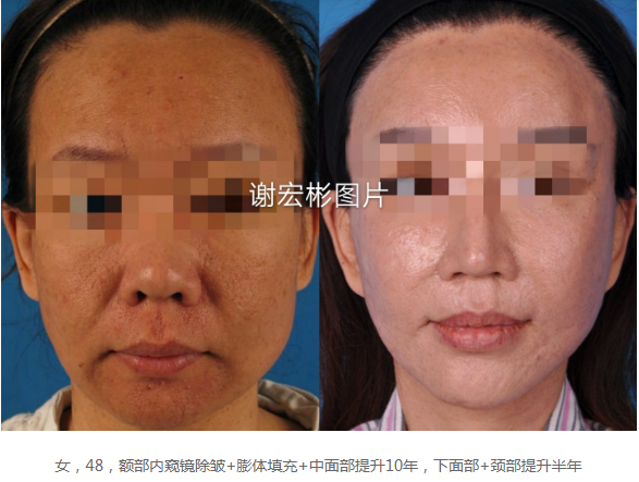 祝东升和谢宏彬谁做的面部大拉皮手术技术更好？