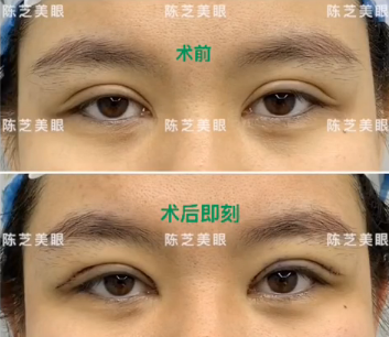 2022年深圳修复双眼皮哪个医生好？