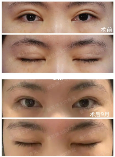 南京二院刘宁和刘育凤谁双眼皮修复技术好？