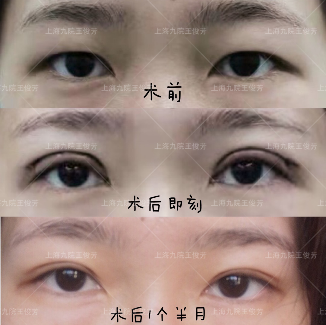 上海九院王俊芳割双眼皮技术口碑怎么样？