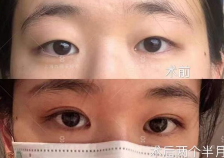 上海九院王俊芳割双眼皮技术评价怎么样？