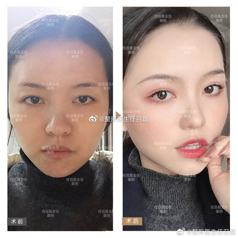 北京画美任召磊做眼睛技术怎么样？