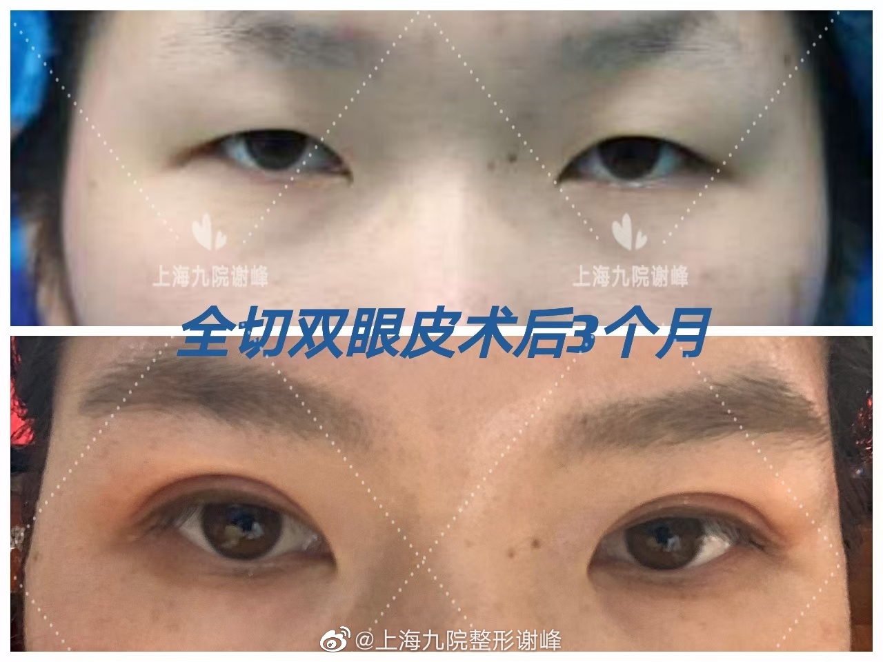 上海谢峰做双眼皮技术口碑怎么样？