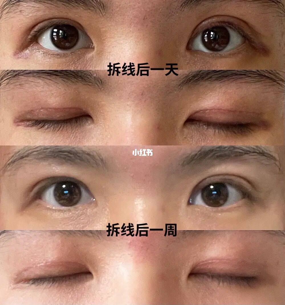 北京八大处哪个医生双眼皮手术最好