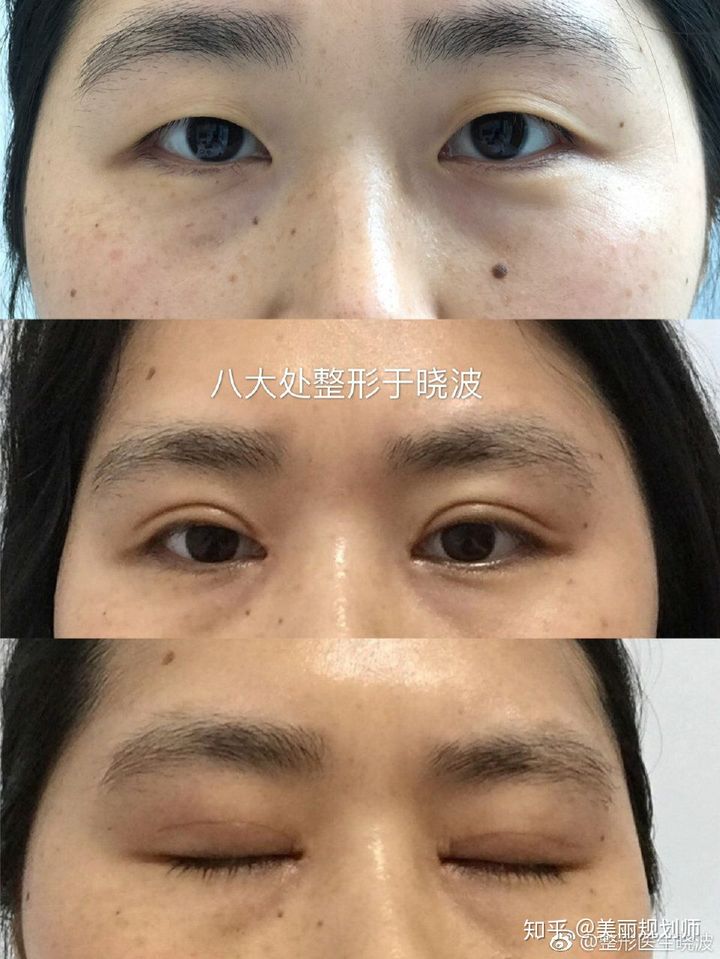 北京八大处于晓波做双眼皮修复怎么样？