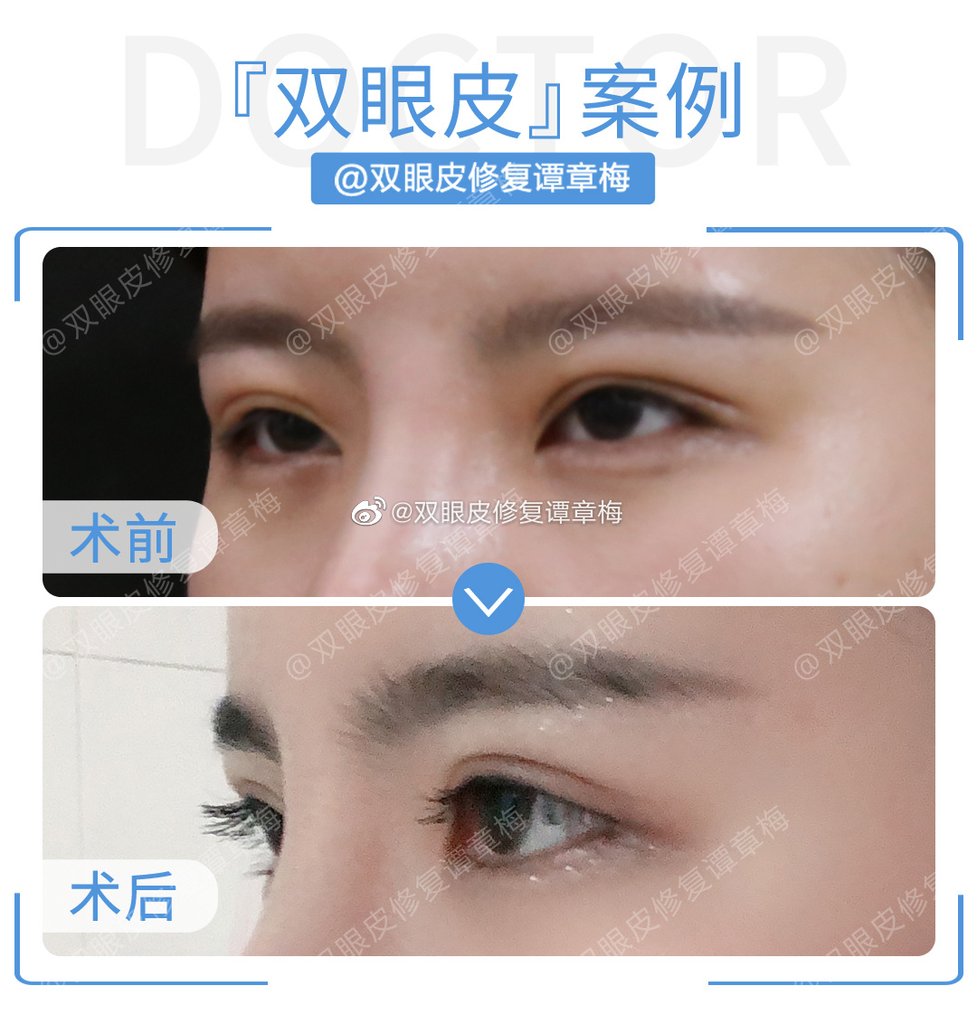 谭章梅修复双眼皮案例