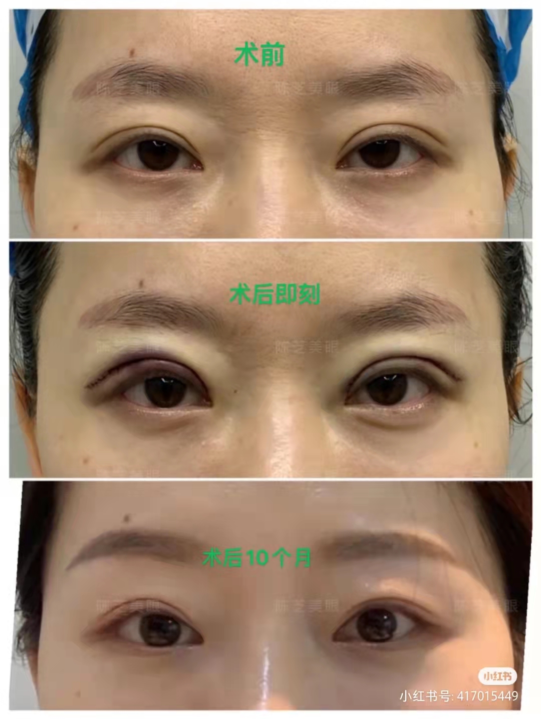 陳芝雙眼皮修復案例
