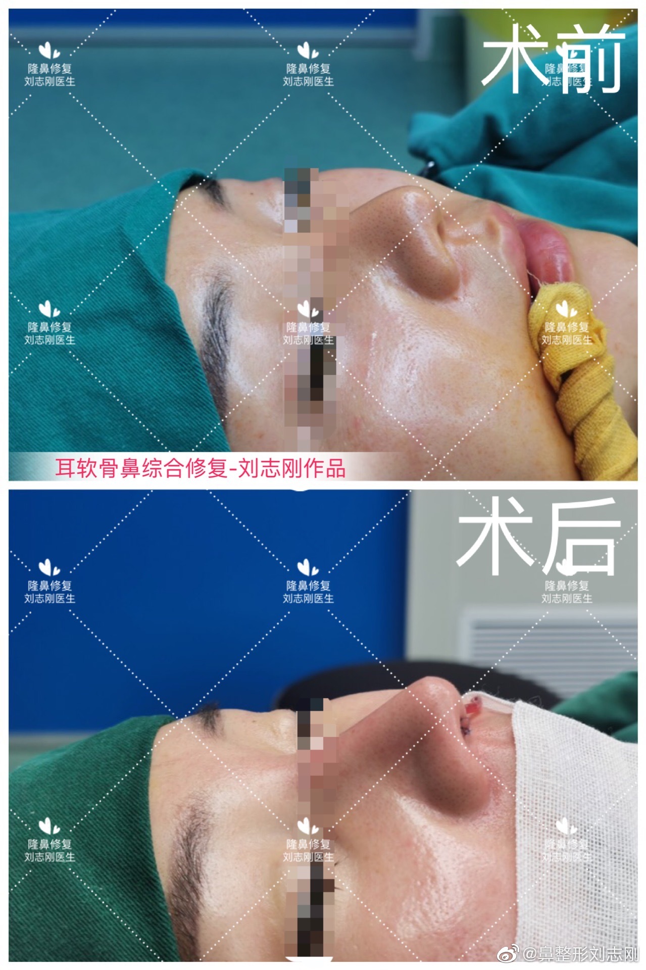 刘志刚做鼻修复案例