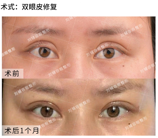 刘辅容修复双眼皮案例