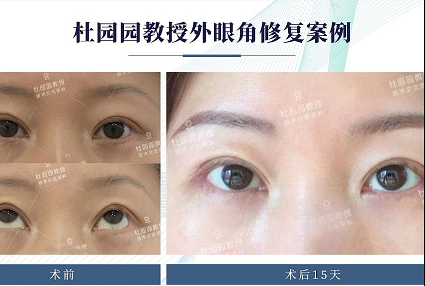 上海杜园园双眼皮修复技术怎么样？