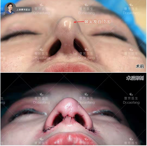 上海曹芳隆鼻修复技术怎么样？