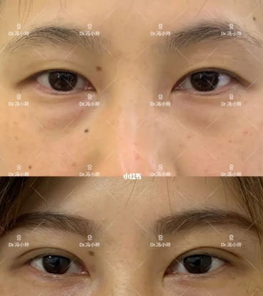 武汉协和冯晓玲双眼皮修复技术怎么样？