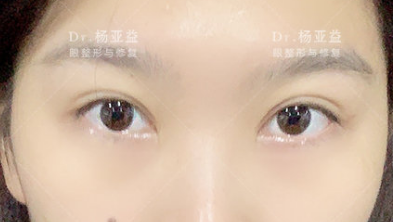 上海杨亚益做双眼皮修复技术怎么样？