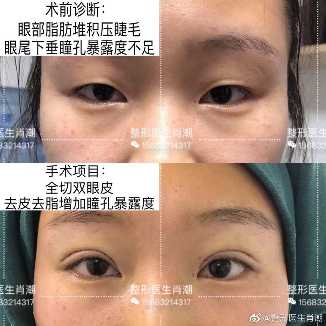 2022年西安最有名的割双眼皮医生有哪些？