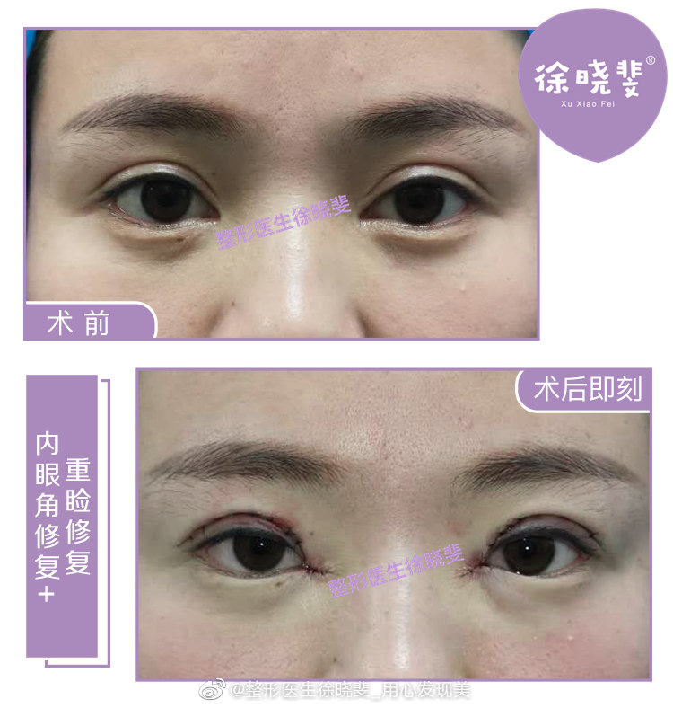 上海徐晓斐修复双眼皮技术口碑怎么样？