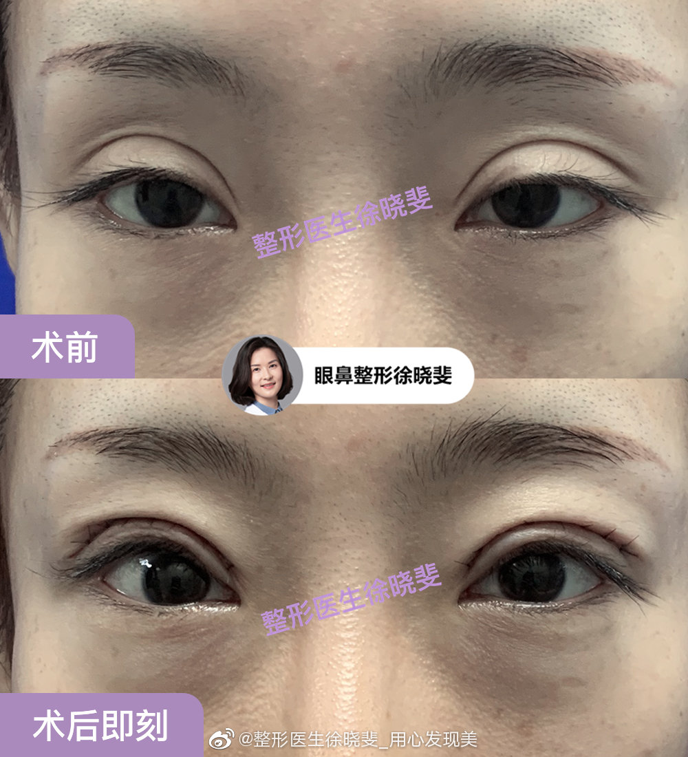 上海双眼皮专家徐晓斐修复眼睛怎么样？