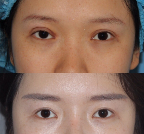 南京做双眼皮修复比较好的医生是谁？