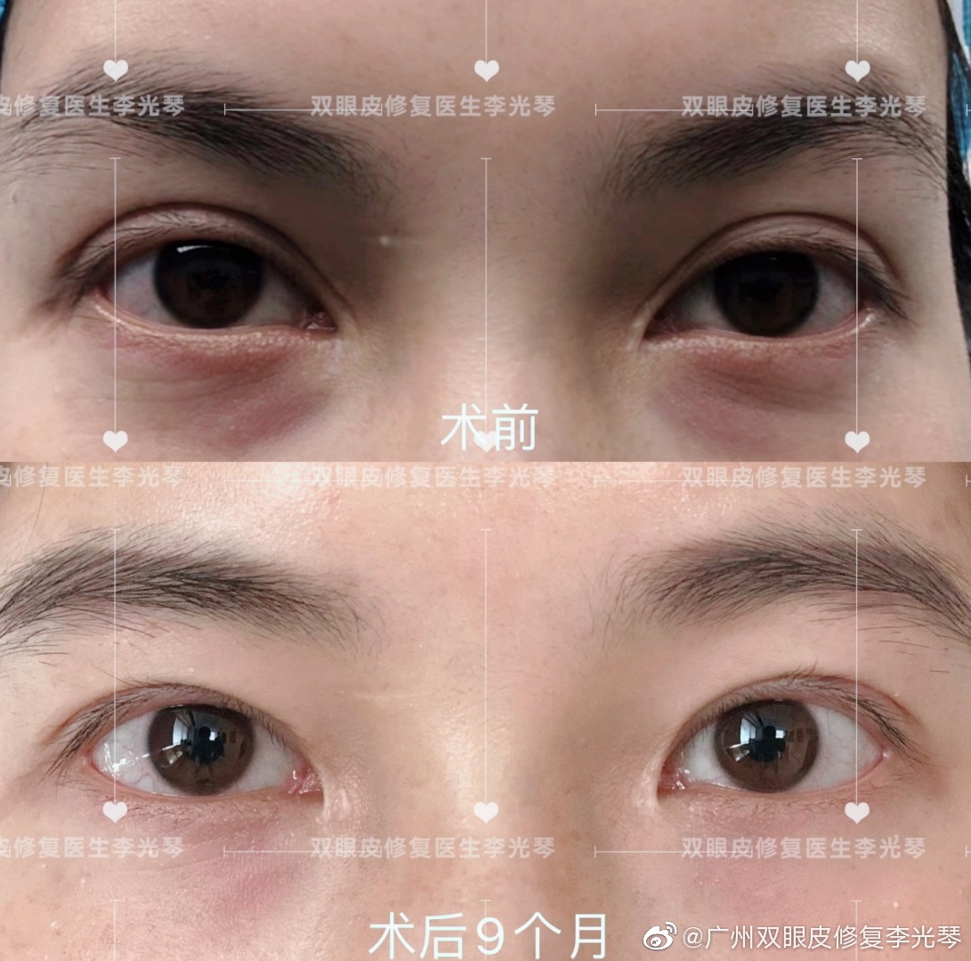 李光琴和冀晨阳修复双眼皮哪个好点