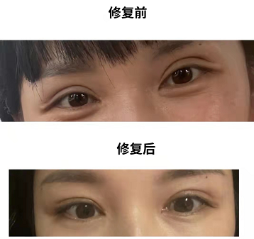 2023年深圳双眼皮修复最好的医生是哪个？