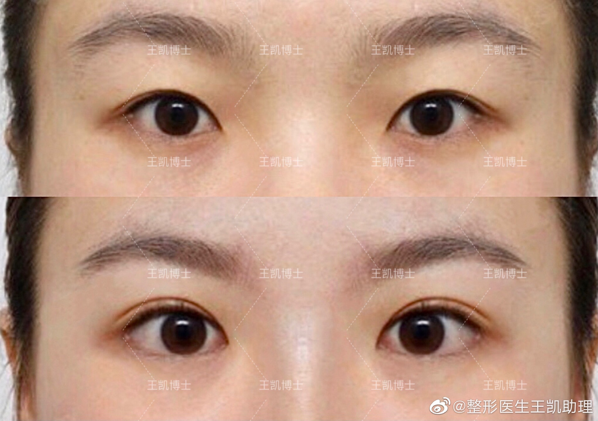 2023年郑州哪个医生双眼皮修复做得最好？