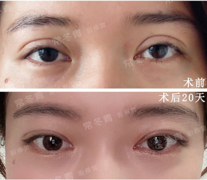 2022年北京高难度修复双眼皮哪个医生更厉害？