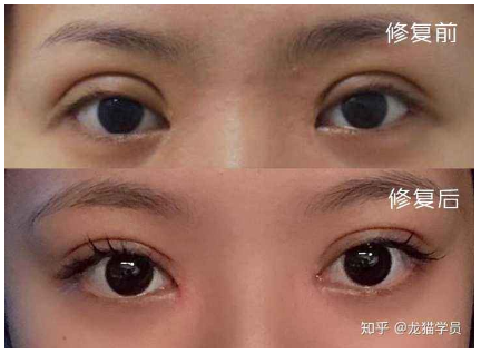 郑州眼修复医生贾亮双眼皮修复技术怎么样？