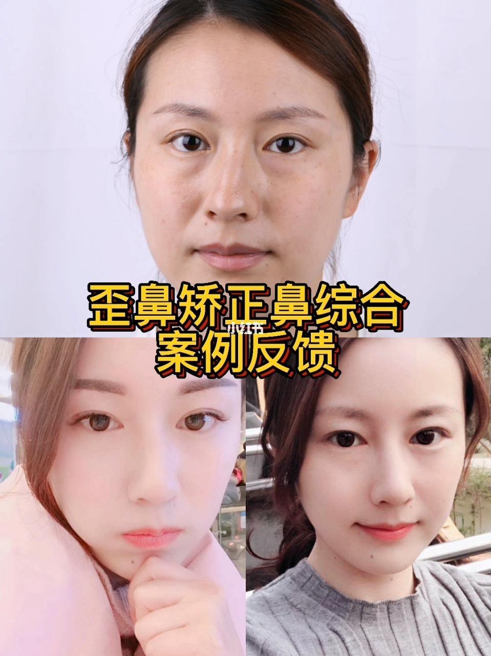 2022年上海九院哪个专家做歪鼻子手术好？