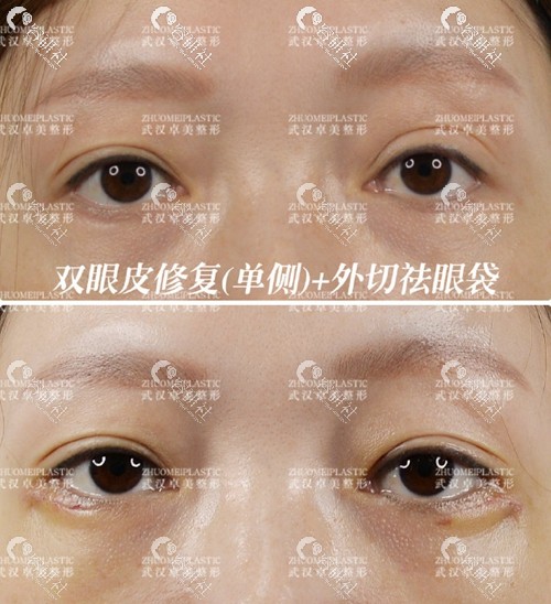 2022年武汉同济医院修复双眼皮最好的专家是谁？