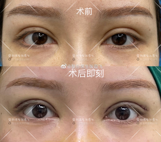 2022年浙江双眼皮修复顶级医生有哪些？