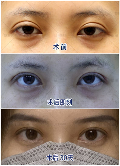 2022年北京修复双眼皮的女专家厉害的有哪些？