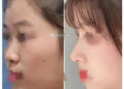 上海九院李圣利做鼻子技术怎么样？