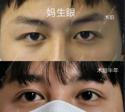 双眼皮专家杨丽和孔宇谁割双眼皮技术好？