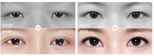 上海双眼皮医生杜园园修复外眼角怎么样？