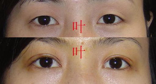 杭州双眼皮专家叶秀娣做双眼皮口碑怎么样？