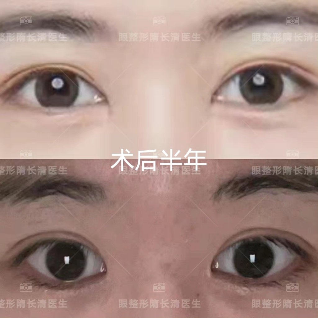 上海眼修复专家隋长青双眼皮修复好吗？