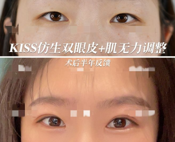 2022年武汉双眼皮医生哪个好？武汉双眼皮专家排名
