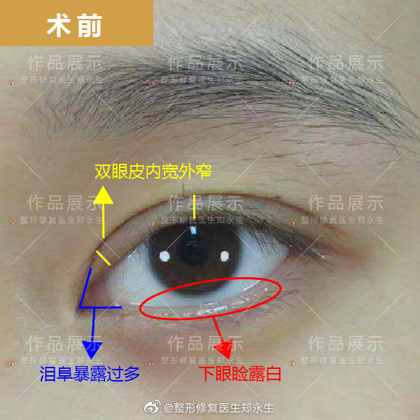 郑永生双眼皮修复