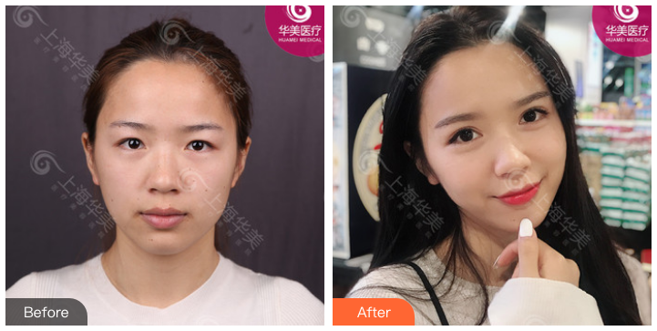 上海华美眼综合杨亚益和百达丽徐晓斐哪个好?