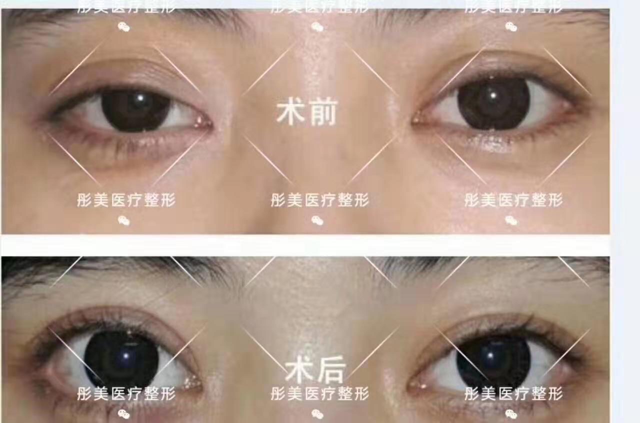 刘风卓双眼皮修复案例
