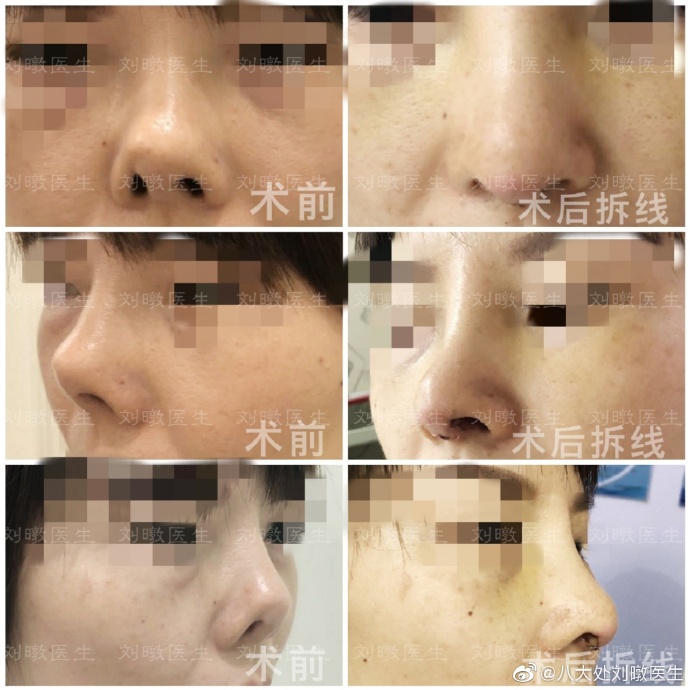 刘暾鼻修复案例
