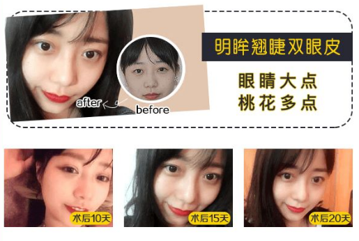 上海割双眼皮好的医院有哪些?