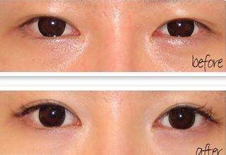 国内双眼皮修复最好的专家是哪个？