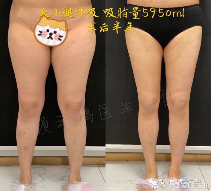 顾云鹏大小腿环吸