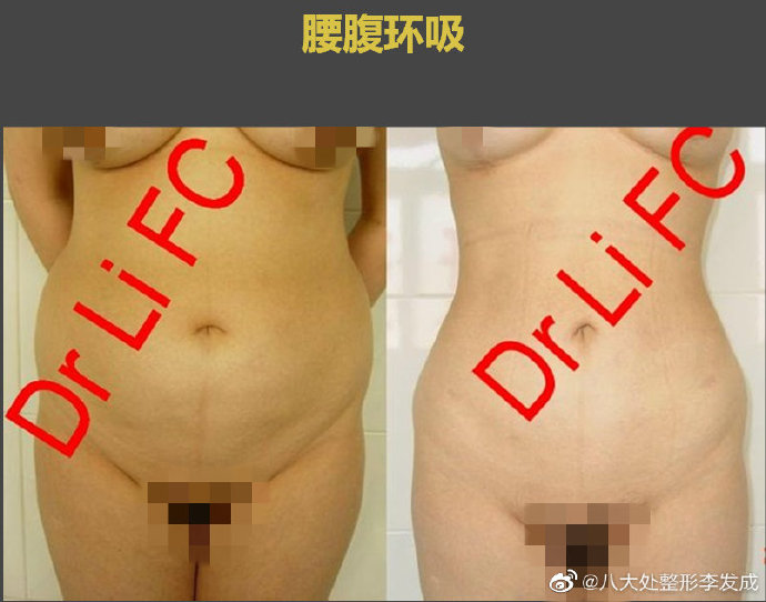 李发成腰腹环吸案例