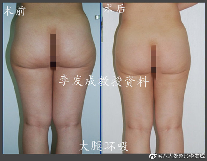 李发成大腿环吸案例