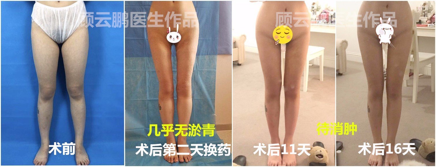 顾云鹏大腿环吸案例