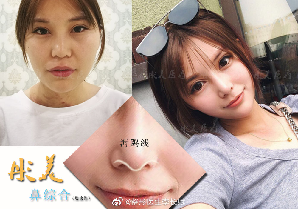 李长赋鼻综合案例
