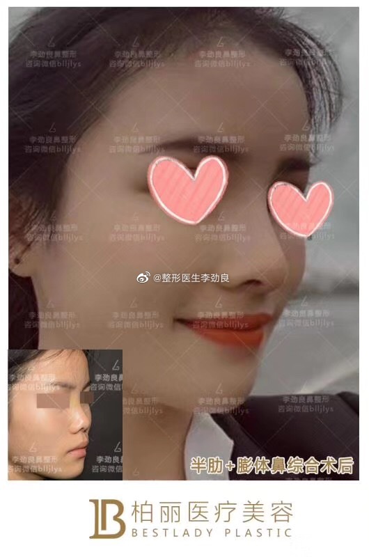 李劲良鼻综合案例