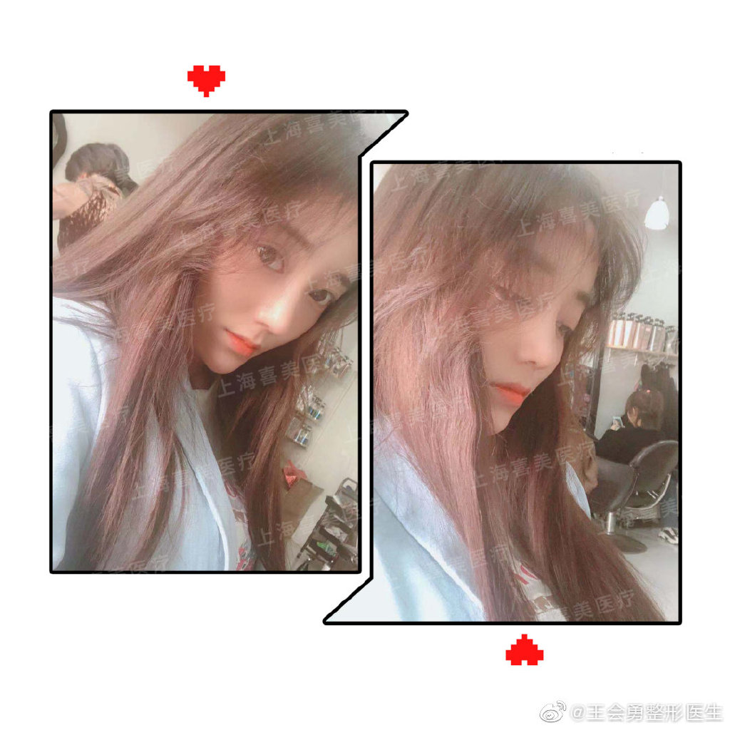 王会勇鼻综合案例
