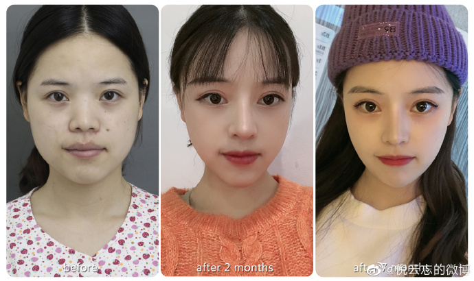 倪云志鼻综合案例